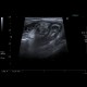 Acute appendicitis, fecolith: US - Ultrasound
